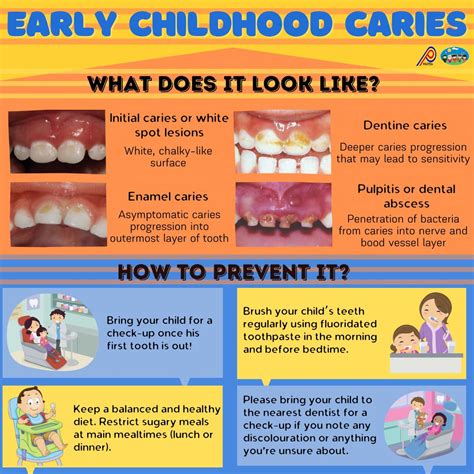 Early childhood caries – Malaysian Association of Paediatric Dentistry