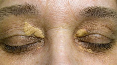 White Bump On Eyelid Causes Treatment Remedies Pictures