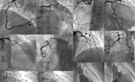 Cateterismo Cardíaco – CIMI - Medicina Cardiovascular