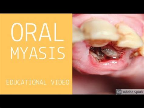 Maggots In Human Nose Nasal Myiasis Youtube - vrogue.co