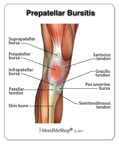 Prepatellar Bursitis