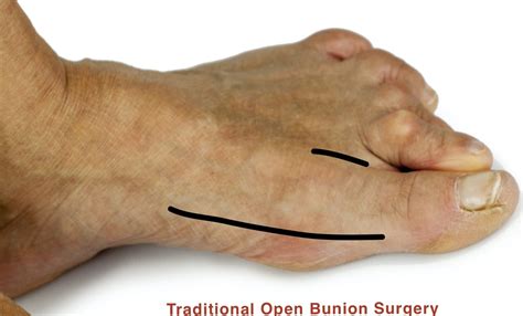 Minimally Invasive operation - Percutaneous Hallux Valgus (Bunion ...