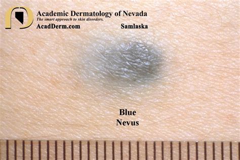 Blue Nevus - Academic Dermatology of Nevada