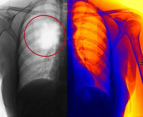 Pleural Mesothelioma Cancer | Symptoms, Prognosis, & Treatment