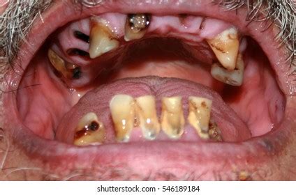 Rotten Teeth Royalty-Free Images, Stock Photos & Pictures | Shutterstock