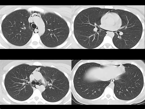 Figure 1. Chest computed tomography (CT) on arrival (The CT showed spontaneous pneumomediastinum ...