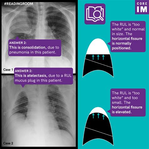 Chest X Ray Consolidation