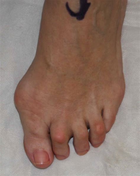 Toe Deformities | The Tagoe Clinic