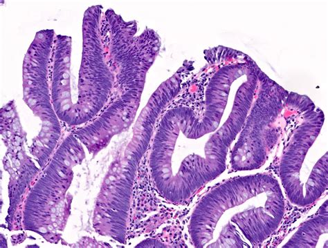 Tubular Adenoma Histology