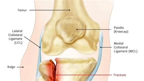 Proximal Tibia/Fibula Fracture - Carolina Regional Orthopedics