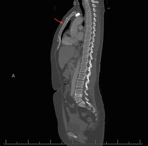 Hennepin Ultrasound | Sternal Fracture Missed on X-ray