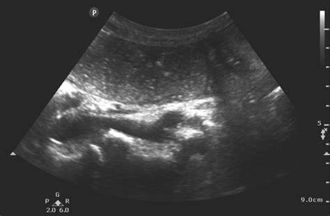 Portal Venous Gas | Emory School of Medicine