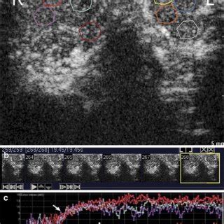 Severe left spermatic cord occlusion. a Final frame from... | Download Scientific Diagram