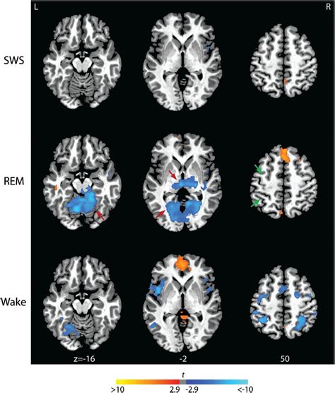 Rhythmic alternating patterns of brain activity distinguish rapid eye ...