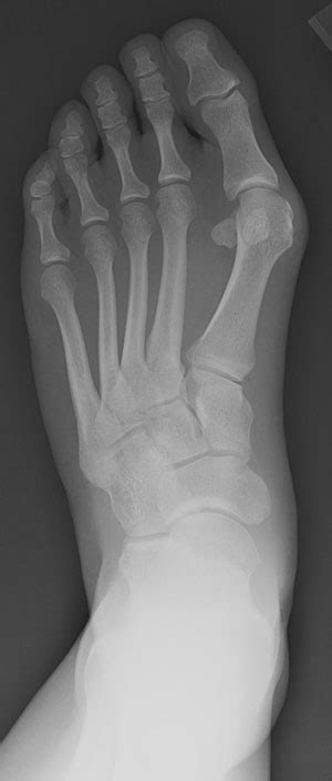 Hallux Valgus - Bunions | UW Orthopaedics and Sports Medicine, Seattle