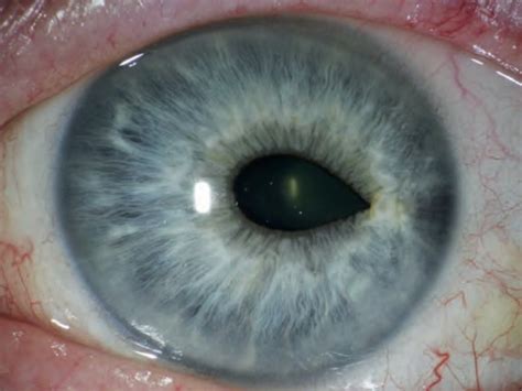 Corneal edema