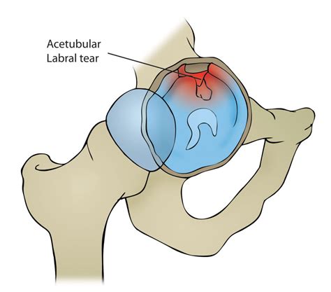 Hip Labral Tear - Motus Physical Therapy