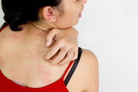 Healthiculture - Skin Rash and Itch in Fibromyalgia