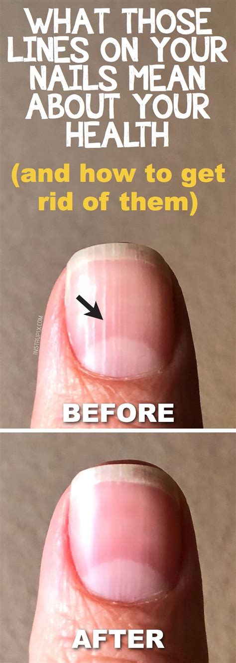 What Those Vertical Lines On Your Nails Mean About Your Health