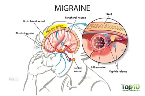 Home Remedies for Migraines | Top 10 Home Remedies