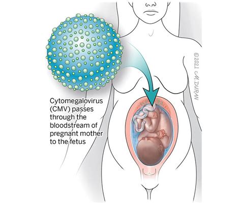 Partners in Care | Cytomegalovirus (CMV) is treated in the…