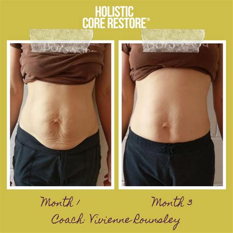 Before & After Diastasis Recti Repair Gallery - Holistic Core Restore