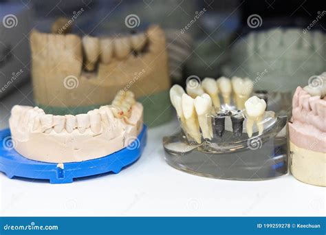 Various Dental Cast Models. Focus on Cast Model with Teeth Implants ...