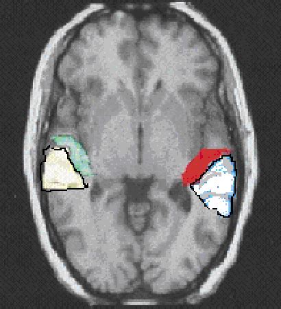 Figure 1 from Planum temporale and planum parietale morphology in children with developmental ...