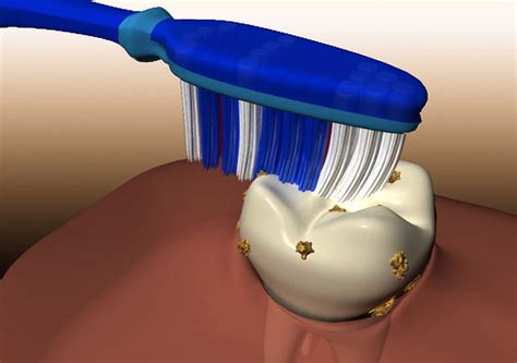 Medical animation - How tooth decay occurs. on Vimeo