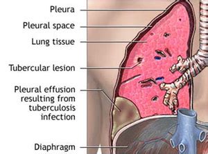 Empyema – Laparoscopic, thoracoscopic and hernia surgery