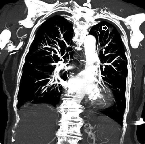 Spiral Computed Tomography for Acute Pulmonary Embolism | Circulation