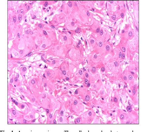 [PDF] Clinicopathologic Characteristics of Apocrine Breast Carcinoma ...