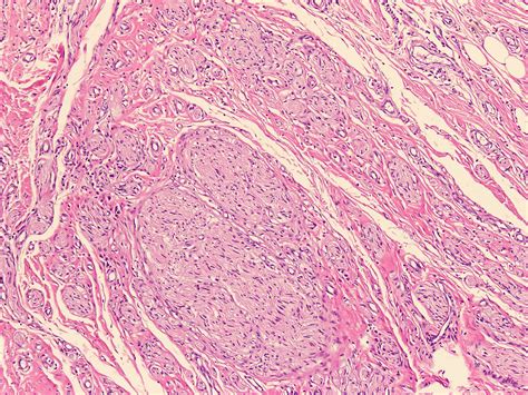 Neuroma Histology