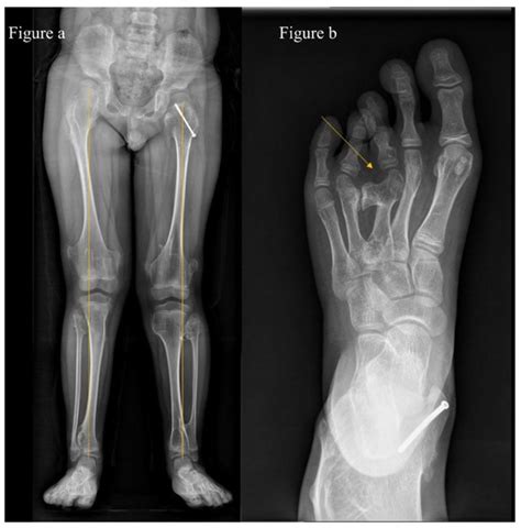 A Genotype-Phenotype Study of Multiple Hereditary Exostoses in Forty-Three Patients