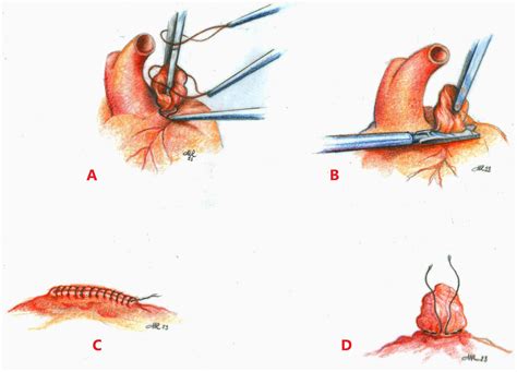 Different Techniques of Surgical Left Atrial Appendage Closure and Their Efficacy: A Systematic ...