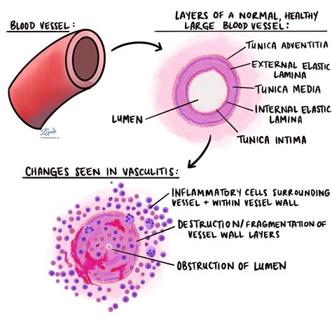 Vasculitis - MyPathologyReport.ca