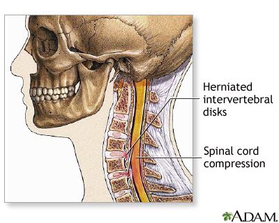 Spinal surgery - cervical - series—Indications: MedlinePlus Medical ...