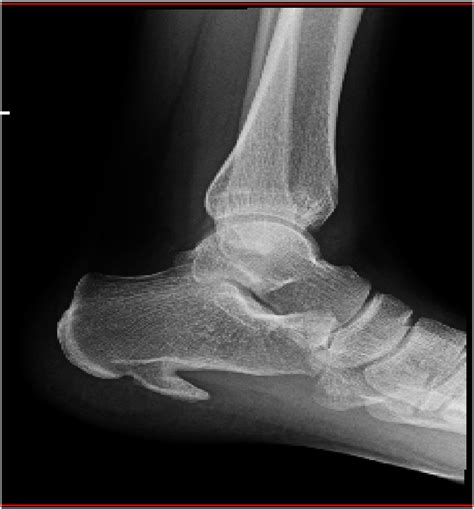 Lateral radiograph of the left ankle joint showing a massive,... | Download Scientific Diagram