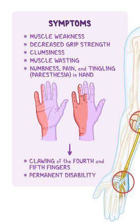 These are the symptoms of Nerve compression syndrome - MEDizzy