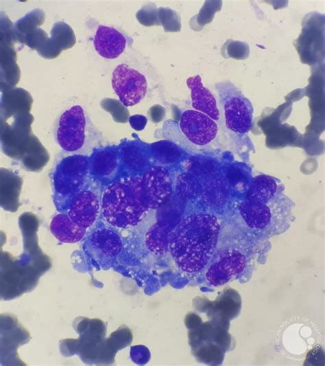 Hypocellular bone marrow with metastatic cells 3