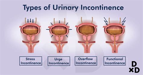 Types Of Incontinence Deals Cheapest, Save 45% | jlcatj.gob.mx