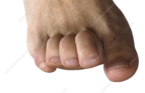 Claw foot in Charcot-Marie-Tooth disease - Stock Image - C016/6903 - Science Photo Library