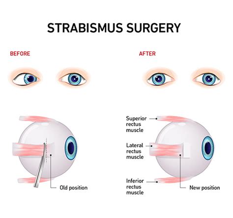 Strabismus surgery