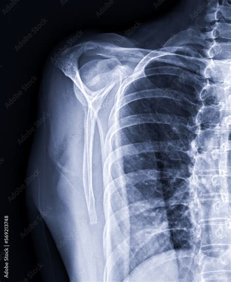 X-ray Shoulder joint shoulder front view for diagnosis fracture of shoulder joint. Stock Photo ...