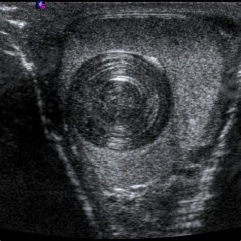 Testicular Epidermoid Cyst