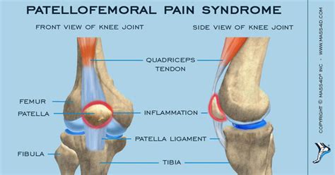 초등학교 축구 선수의 무릎 통증 - 오스굿 슐라터 병(Osgood-Schlatter Disease, OSD) : 네이버 블로그