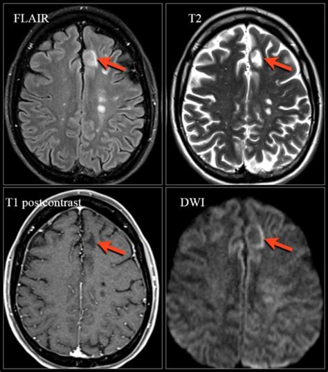 Ms Mri Brain Scan Results