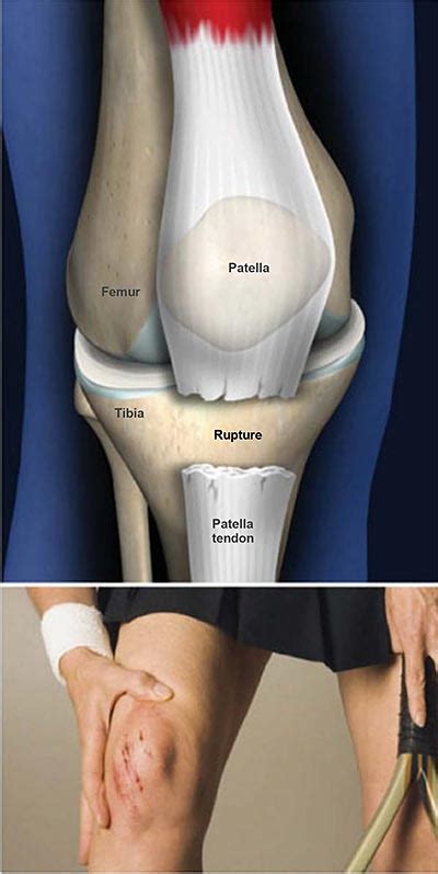 Patella Tendon Rupture | Central Coast Orthopedic Medical Group