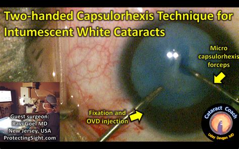 Two-Handed Capsulorhexis Technique – Cataract Coach™