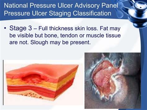 Pressure sores presentation